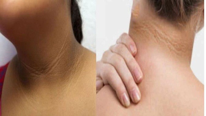 Black spots on the neck? How to eliminate? Here are some tips to help you get started: